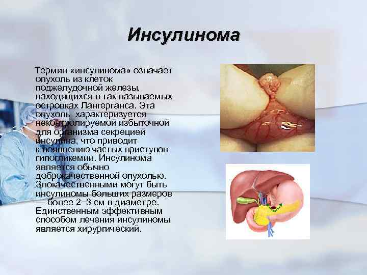 Инсулинома Термин «инсулинома» означает опухоль из клеток поджелудочной железы, находящихся в так называемых островках