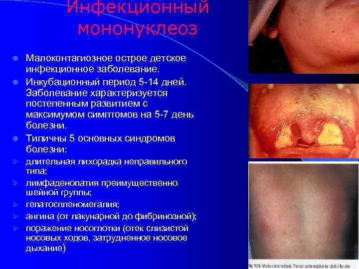 Инфекционный мононуклеоз Малоконтагиозное острое детское инфекционное заболевание. l Инкубационный период 5 -14 дней. Заболевание