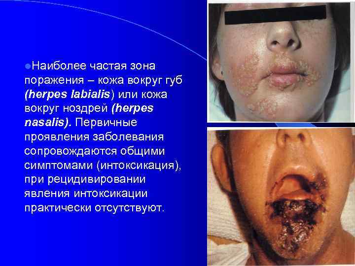 l. Наиболее частая зона поражения – кожа вокруг губ (herpes labialis) или кожа вокруг