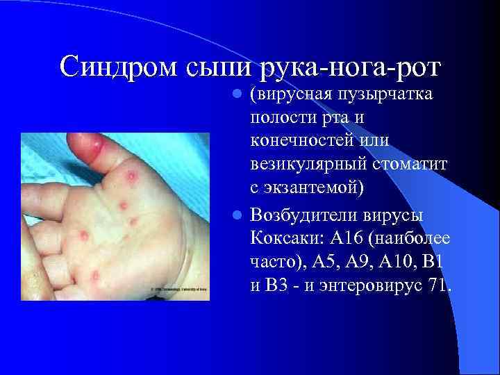 Синдром сыпи рука нога рот (вирусная пузырчатка полости рта и конечностей или везикулярный стоматит