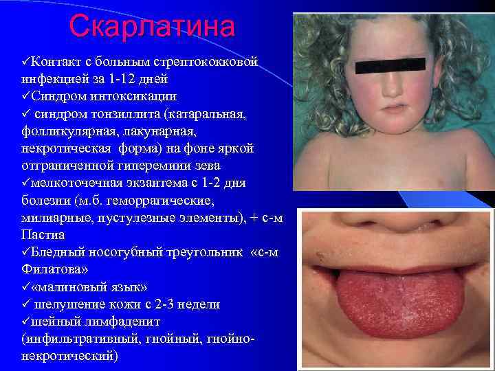 Скарлатина üКонтакт с больным стрептококковой инфекцией за 1 12 дней üСиндром интоксикации ü синдром