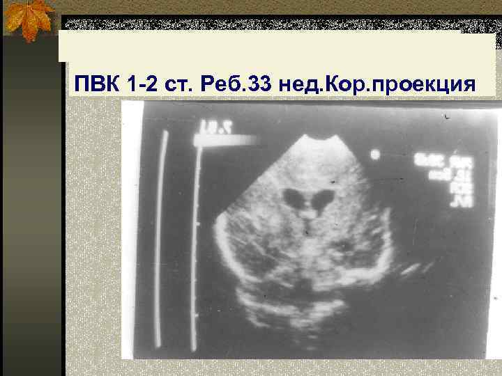 ПВК 1 -2 ст. Реб. 33 нед. Кор. проекция 