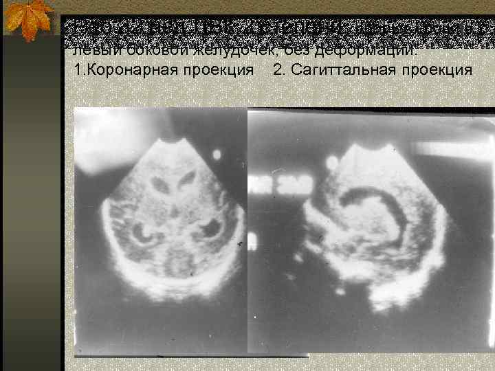 Реб. 32 нед. ПВК 2 степени, прорыв крови в 1 левый боковой желудочек, без