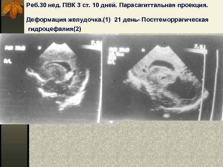 Реб. 30 нед. ПВК 3 ст. 10 дней. Парасагиттальная проекция. 3 Деформация желудочка. (1)