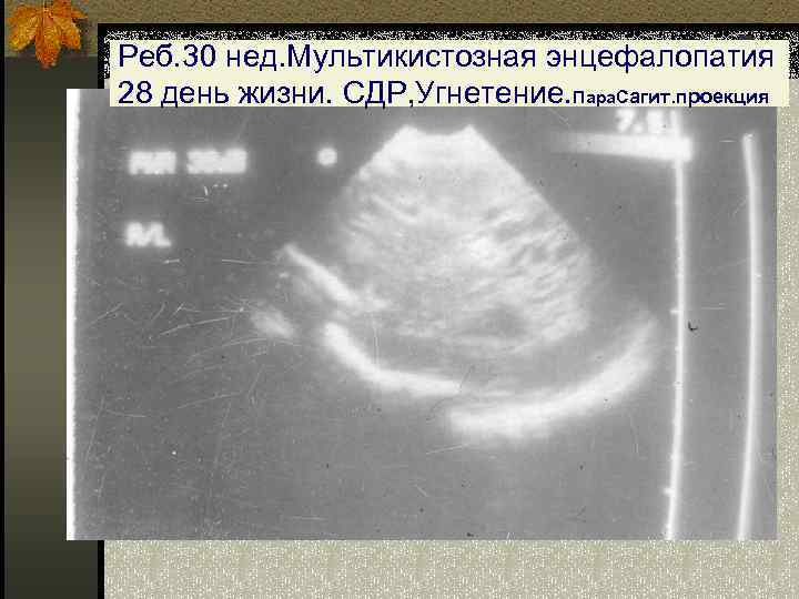5 Реб. 30 нед. Мультикистозная энцефалопатия 28 день жизни. СДР, Угнетение. Пара. Сагит. проекция