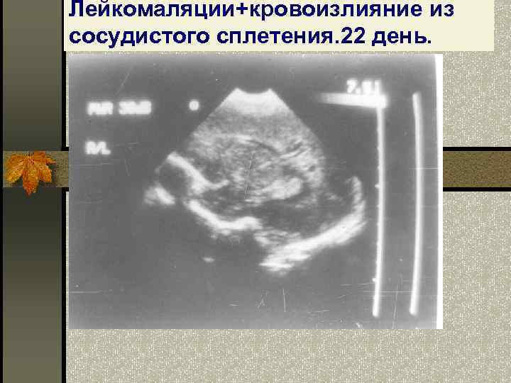 Лейкомаляции+кровоизлияние из сосудистого сплетения. 22 день. 