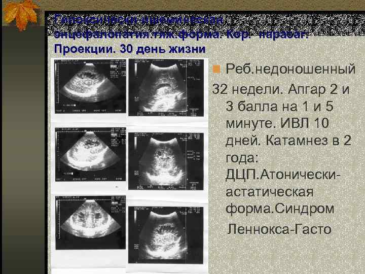 Гипоксически-ишемическая энцефалопатия. тяж. форма. Кор. парасаг. Проекции. 30 день жизни n Реб. недоношенный 32