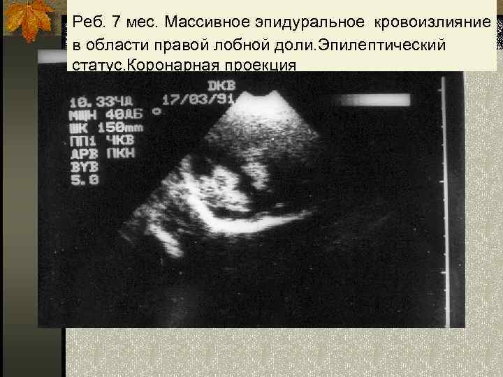  Реб. 7 мес. Массивное эпидуральное кровоизлияние в области правой лобной доли. Эпилептический статус.