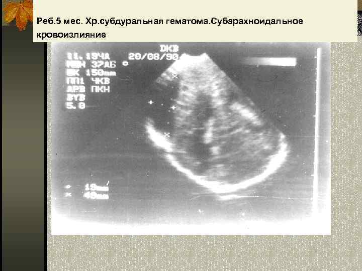 Реб. 5 мес. Хр. субдуральная гематома. Субарахноидальное кровоизлияние 
