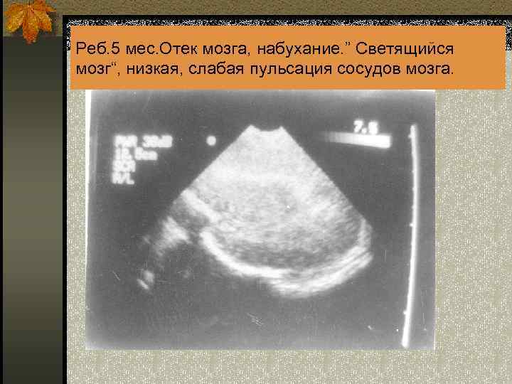 Реб. 5 мес. Отек мозга, набухание. ” Светящийся мозг“, низкая, слабая пульсация сосудов мозга.