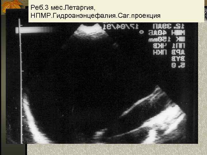 Реб. 3 мес. Летаргия, НПМР. Гидроанэнцефалия. Саг. проекция 10 