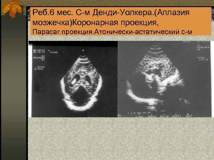 Реб. 6 мес. С-м Денди-Уолкера. (Аплазия 11 мозжечка)Коронарная проекция, Парасаг. проекция. Атонически-астатический с-м 