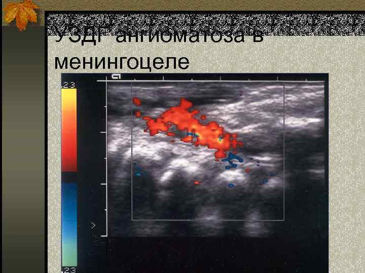 УЗДГ ангиоматоза в менингоцеле 