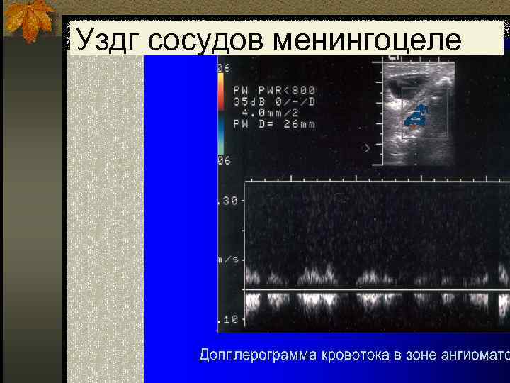Уздг сосудов менингоцеле 