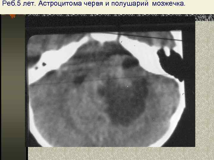 Астроцитома мозжечка, реб. 3 года Реб. 5 лет. Астроцитома червя и полушарий мозжечка.