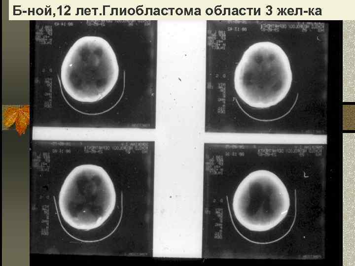 Б-ной, 12 лет. Глиобластома области 3 жел-ка 