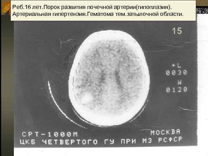Реб. 16 лет. Порок развития почечной артерии(гипоплазия). Артериальная гипертензия. Гематома тем. затылочной области. 15