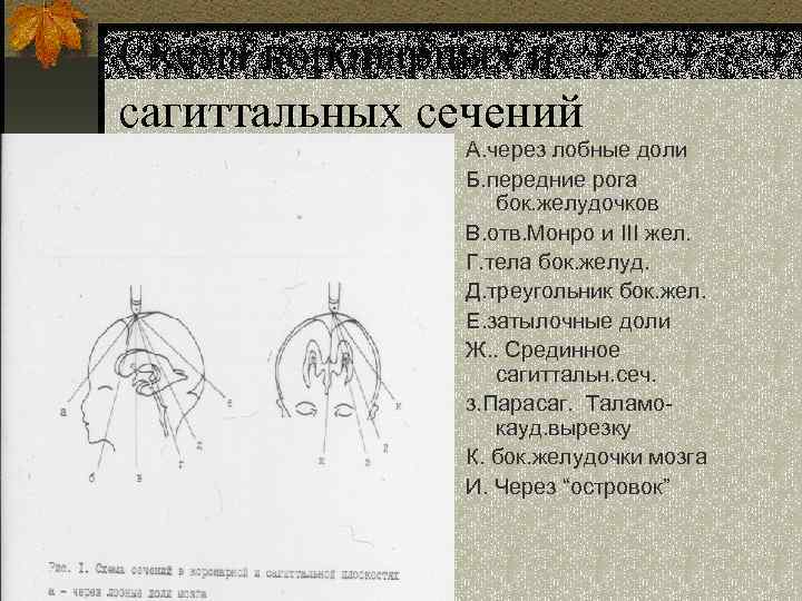 Схема коронарных и сагиттальных сечений А. через лобные доли Б. передние рога бок. желудочков