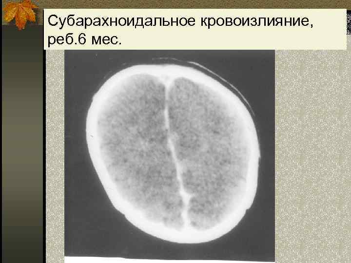 Субарахноидальное кровоизлияние, реб. 6 мес. 