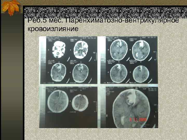 Реб. 5 мес. Паренхиматозно-вентрикулярное кровоизлияние 