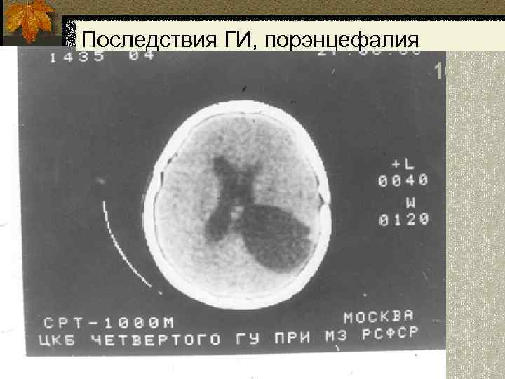 Последствия ГИ, порэнцефалия 16 