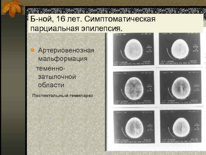 Б-ной, 16 лет. Симптоматическая парциальная эпилепсия. n Артериовенозная мальформация теменнозатылочной области Постиктальный гемипарез 