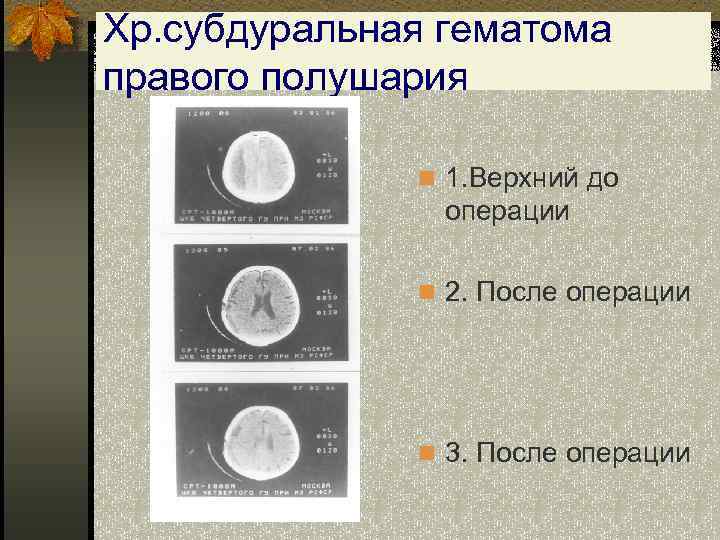 Хр. субдуральная гематома правого полушария n 1. Верхний до операции n 2. После операции