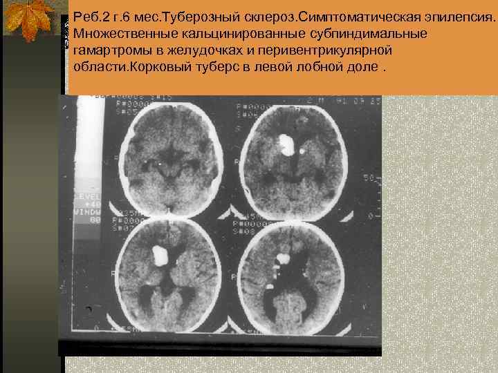 Реб. 2 г. 6 мес. Туберозный склероз. Симптоматическая эпилепсия. Множественные кальцинированные субпиндимальные гамартромы в