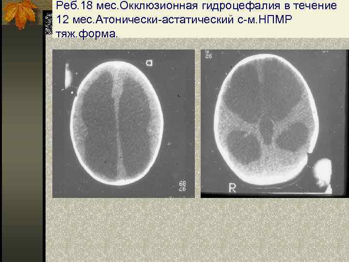 Реб. 18 мес. Окклюзионная гидроцефалия в течение 12 мес. Атонически-астатический с-м. НПМР тяж. форма.