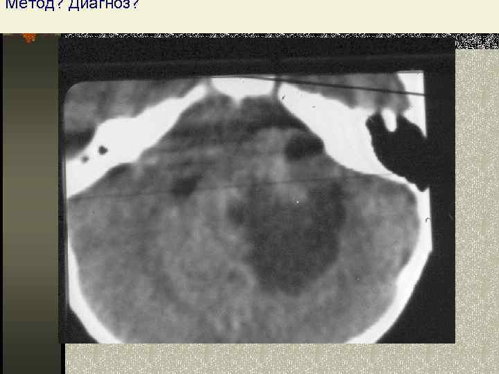 Метод? Диагноз? Астроцитома мозжечка, реб. 3 года 