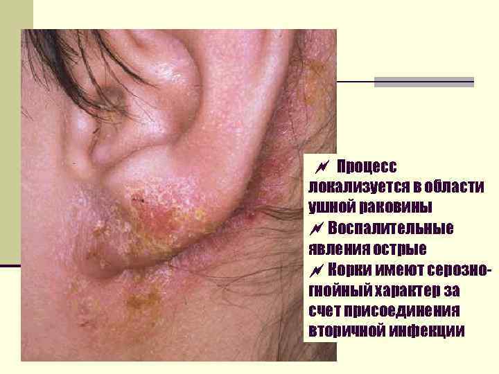  Процесс локализуется в области ушной раковины Воспалительные явления острые Корки имеют серозногнойный характер