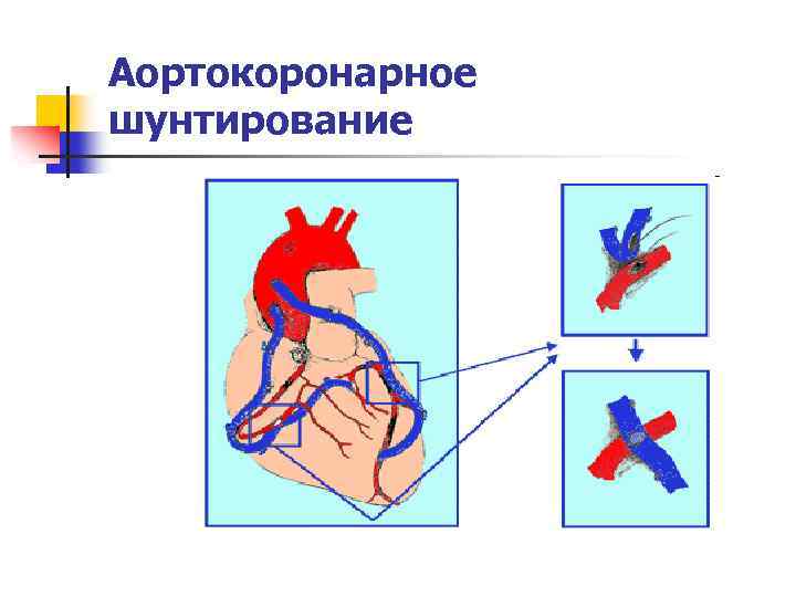 Аортокоронарное шунтирование как делается. Аортокоронарное шунтирование. Аортокоронарное шунтирование операция. Схема операции аортокоронарного шунтирования. Аортокоронарное шунтирование при стенокардии.