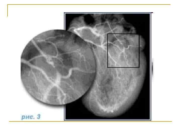 Узи коронарных артерий. Инфаркт миокарда рентген мрт кт. Рентгенография при инфаркте миокарда. Коронарография инфаркт миокарда. Коронарография при инфаркте миокарда.