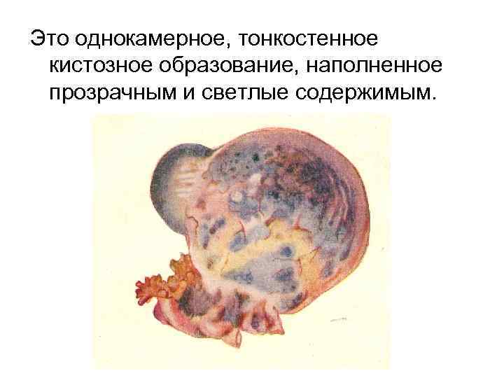 Это однокамерное, тонкостенное кистозное образование, наполненное прозрачным и светлые содержимым. 