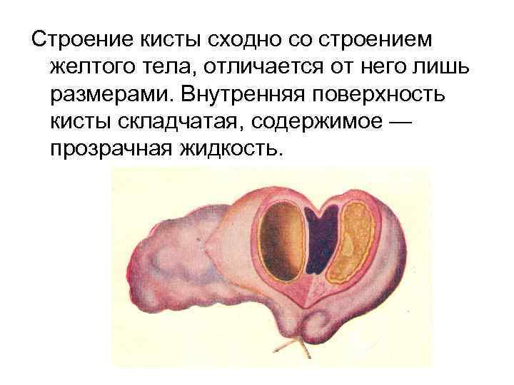 Строение кисты сходно со строением желтого тела, отличается от него лишь размерами. Внутренняя поверхность