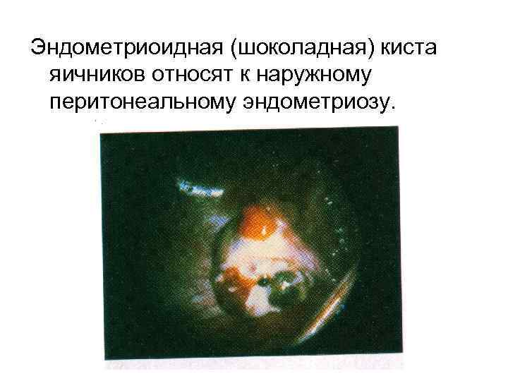 Эндометриоидная (шоколадная) киста яичников относят к наружному перитонеальному эндометриозу. 