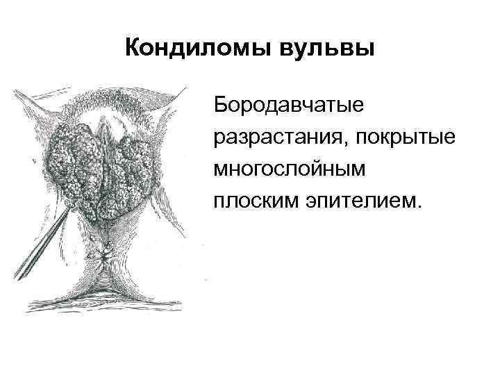 Кондиломы вульвы Бородавчатые разрастания, покрытые многослойным плоским эпителием. 