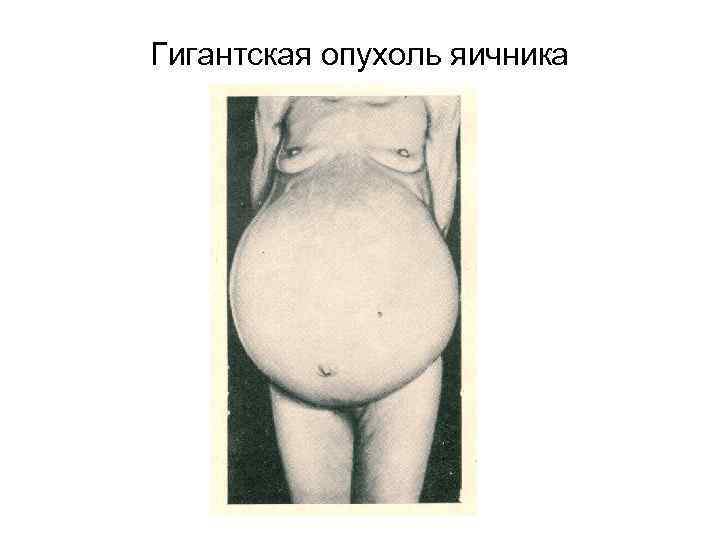 Гигантская опухоль яичника 