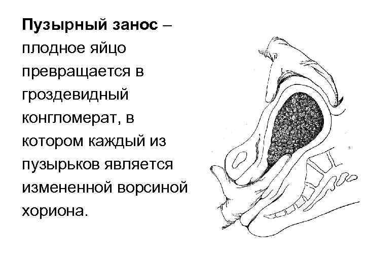 Пузырный занос – плодное яйцо превращается в гроздевидный конгломерат, в котором каждый из пузырьков