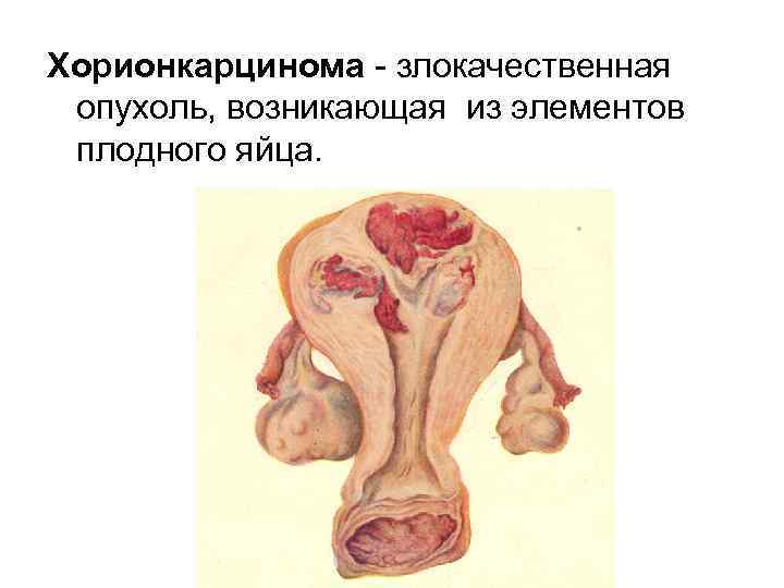 Хорионкарцинома злокачественная опухоль, возникающая из элементов плодного яйца. 