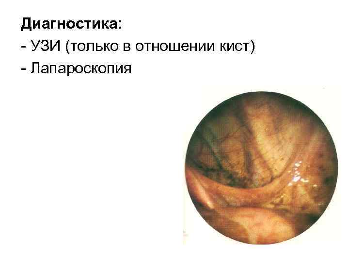 Диагностика: УЗИ (только в отношении кист) Лапароскопия 