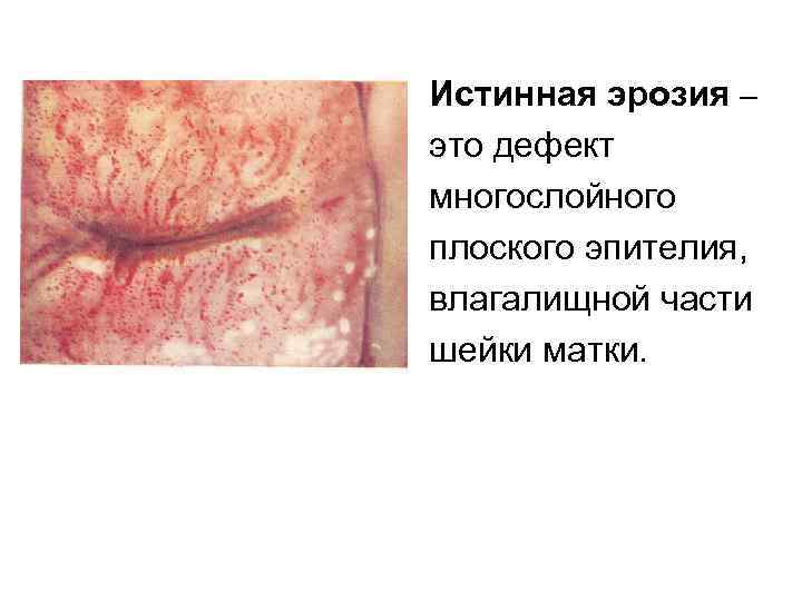 Истинная эрозия – это дефект многослойного плоского эпителия, влагалищной части шейки матки. 