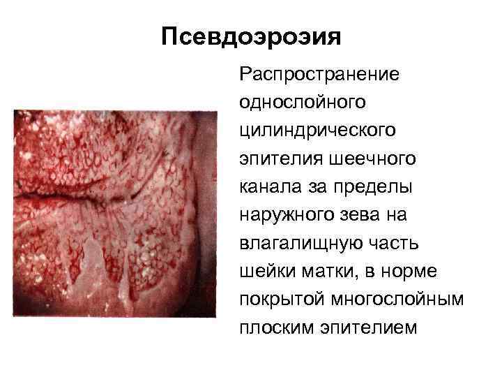 Псевдоэроэия Распространение однослойного цилиндрического эпителия шеечного канала за пределы наружного зева на влагалищную часть
