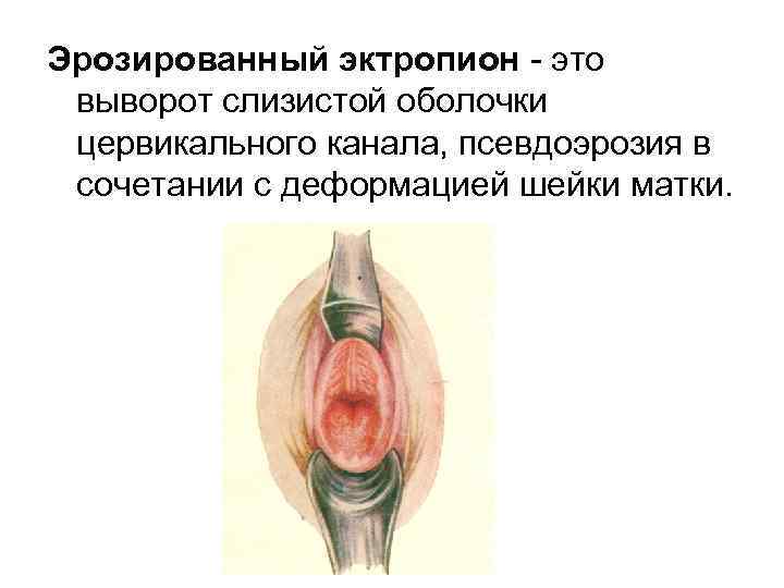 Эрозированный эктропион это выворот слизистой оболочки цервикального канала, псевдоэрозия в сочетании с деформацией шейки