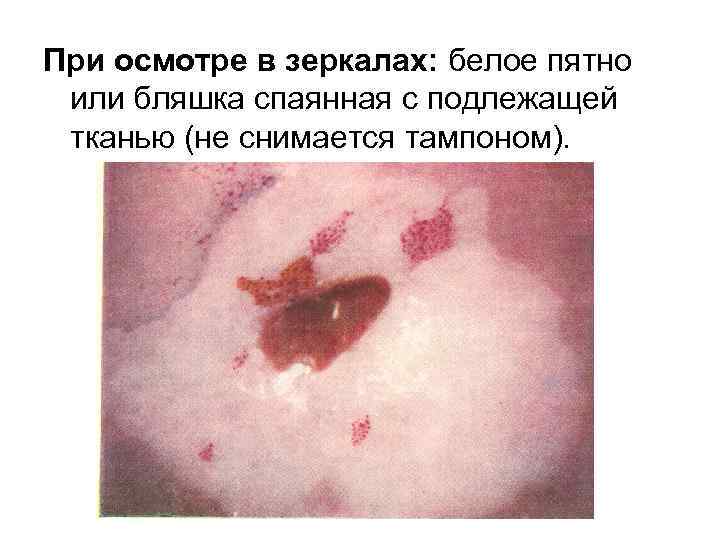 При осмотре в зеркалах: белое пятно или бляшка спаянная с подлежащей тканью (не снимается