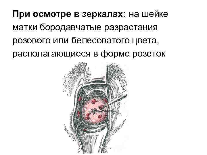 При осмотре в зеркалах: на шейке матки бородавчатые разрастания розового или белесоватого цвета, располагающиеся