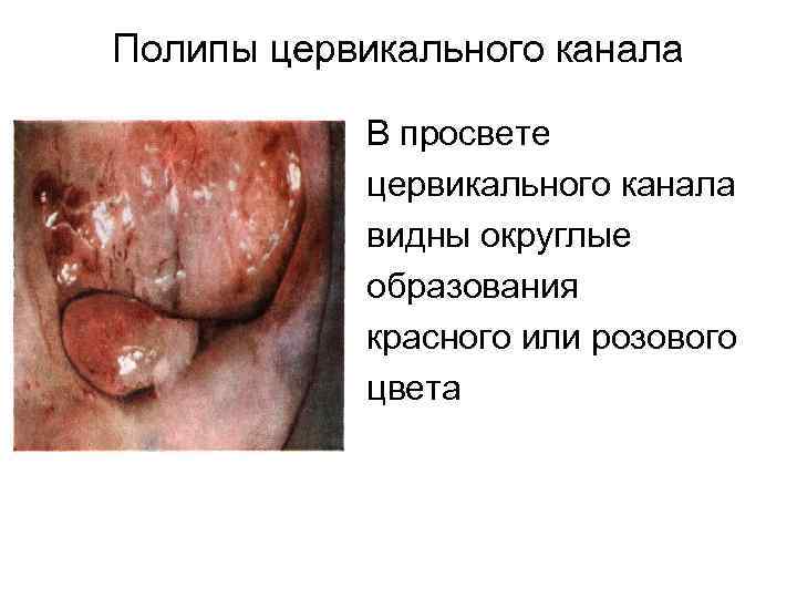 Полипы цервикального канала В просвете цервикального канала видны округлые образования красного или розового цвета