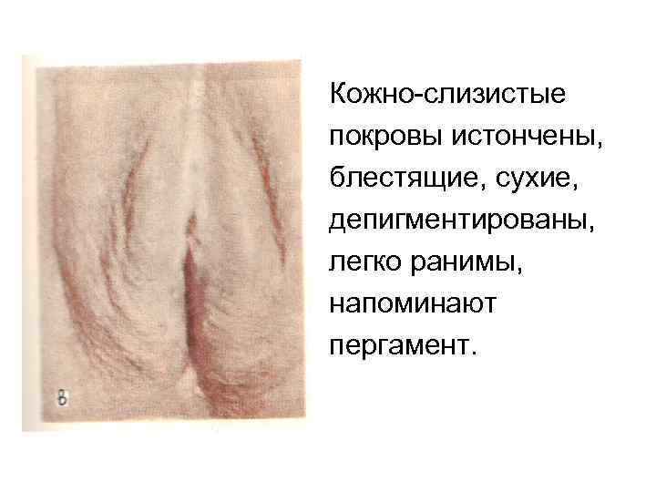 Кожно слизистые покровы истончены, блестящие, сухие, депигментированы, легко ранимы, напоминают пергамент. 