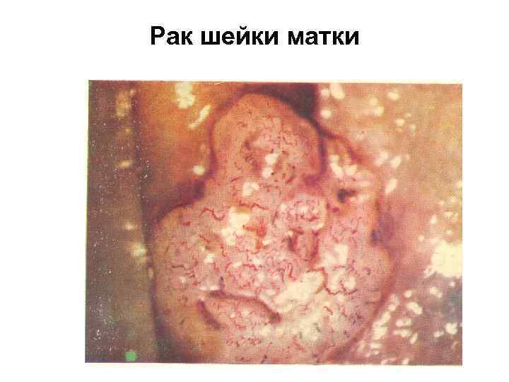 Рак шейки матки 