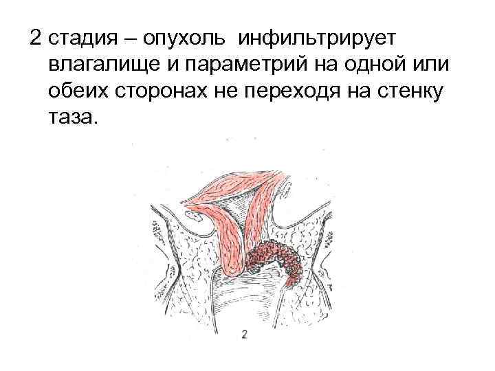 2 стадия – опухоль инфильтрирует влагалище и параметрий на одной или обеих сторонах не